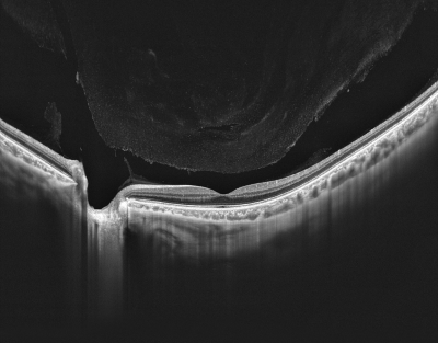 Oct Rift DREAM OCT™ – Intalight